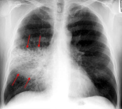 PNUEMONIA ASMA BRONQUITE BRONQUIOLITE CANSAÇO DESCONFORTO RESPIRATORIO CHIADO SIBILO SIBILANCIA 
DOR TORACICA 