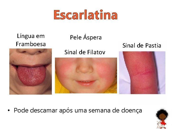 escarlatina
pediatria 
pediatra em salvador 